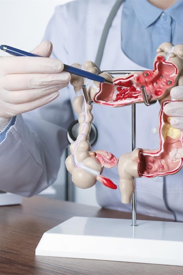 Consejos para evitar el cáncer de colón
