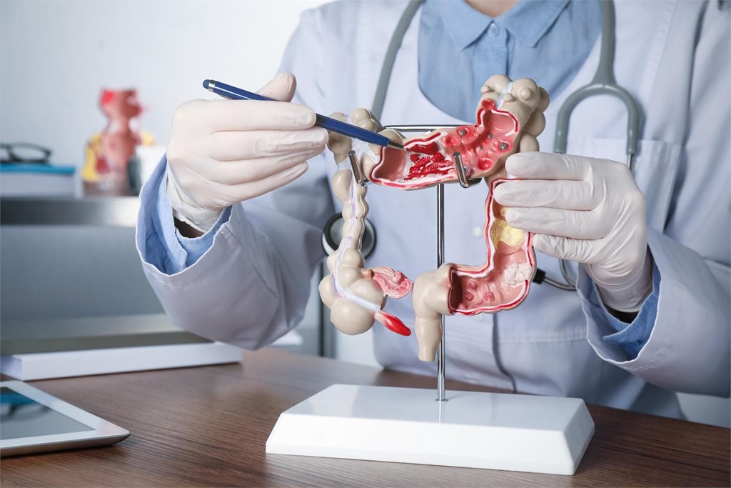 Consejos para evitar el cáncer de colón