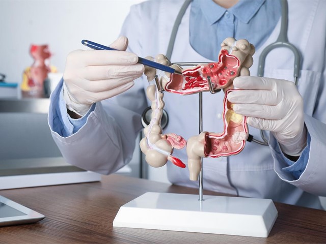 Consejos para evitar el cáncer de colón