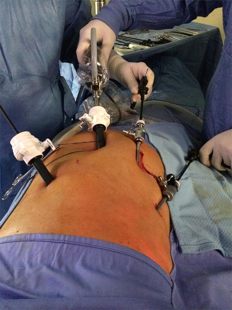 ¿En qué consiste la cirugía laparoscópica?