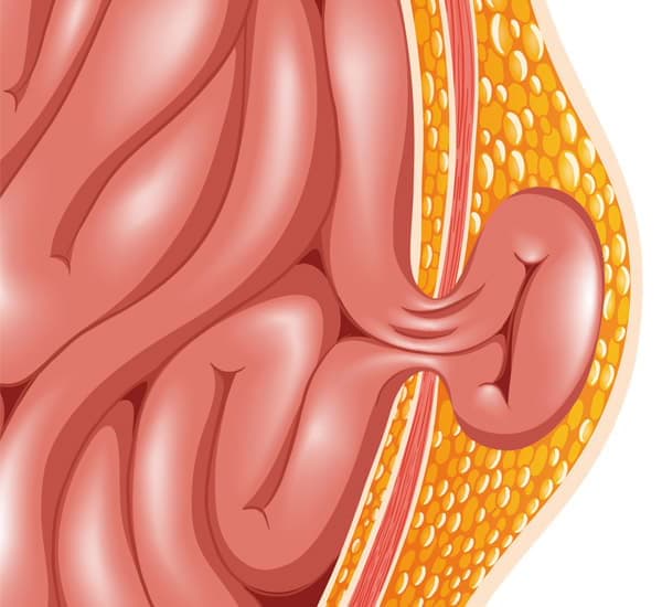 Hernia - Coloproctología