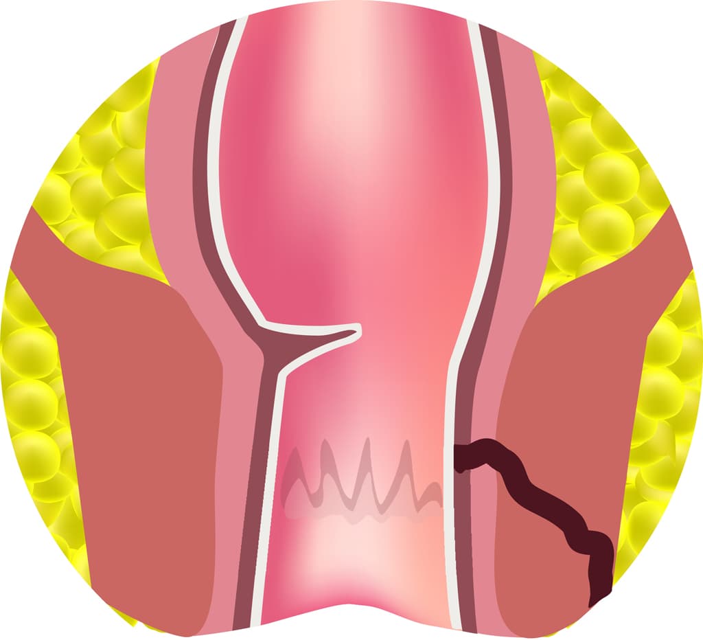 Fístula de ano en Ourense y en Vigo