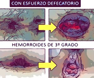 Hemorroide externa Vigo