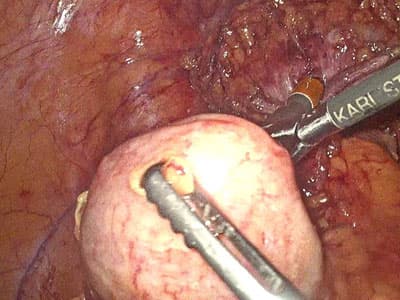 Cirugía laparoscópica en Ourense y Vigo