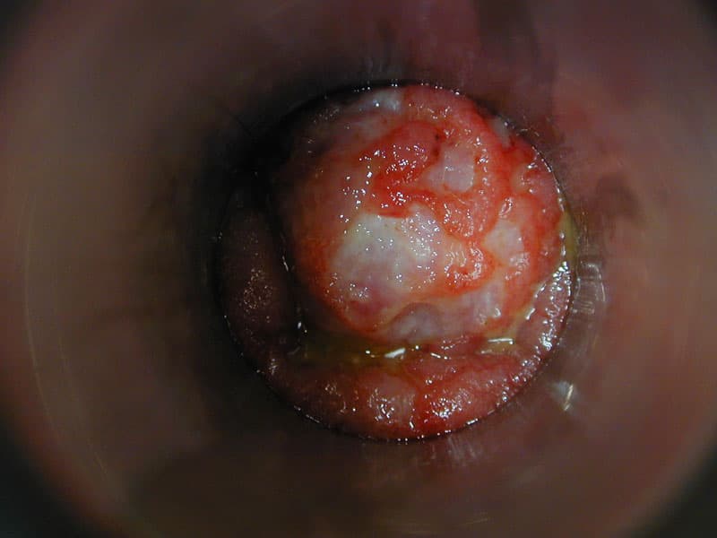 Colitis ulcerosa - Dr. Alberto Parajó Calvo