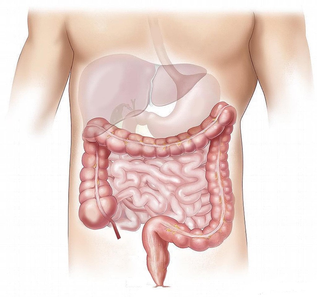 ¿Qué es la enfermedad de Crohn?