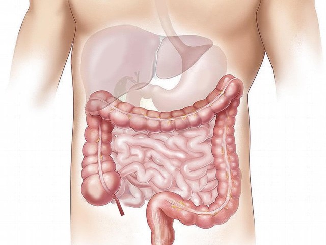 ¿Qué es la enfermedad de Crohn?